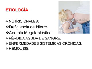 ETIOLOGÍA
 NUTRICIONALES:
Deficiencia de Hierro.
Anemia Megaloblástica.
 PÉRDIDA AGUDA DE SANGRE.
 ENFERMEDADES SISTÉMICAS CRONICAS.
 HEMOLISIS.
 