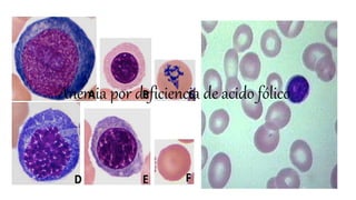 Anemia CLASIFICACIÓN - 
