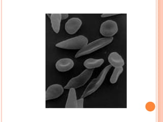 Aborto e Anemia falciforme