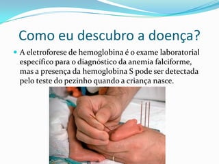 Como eu descubro a doença?
 A eletroforese de hemoglobina é o exame laboratorial
 específico para o diagnóstico da anemia falciforme,
 mas a presença da hemoglobina S pode ser detectada
 pelo teste do pezinho quando a criança nasce.
 