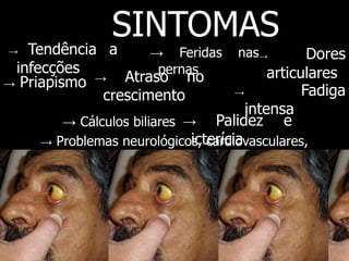 → Palidez e
icterícia
SINTOMAS
→ Tendência a
infecções
→ Feridas nas
pernas
→ Dores
articulares
→ Fadiga
intensa
→ Atraso no
crescimento
→ Cálculos biliares
→ Problemas neurológicos, cardiovasculares,
pulmonares e renais
→ Priapismo
 