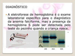 .
DIAGNÓSTICO
 A eletroforese de hemoglobina é o exame
laboratorial específico para o diagnóstico
da anemia falciforme, mas a presença da
hemoglobina S pode ser detectada pelo
teste do pezinho quando a criança nasce.
 