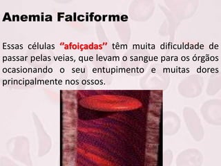 Anemia Falciforme
Essas células ‘’afoiçadas’’ têm muita dificuldade de
passar pelas veias, que levam o sangue para os órgãos
ocasionando o seu entupimento e muitas dores
principalmente nos ossos.
 
