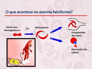 O2
Destruição das
células
Entupimento
dos vasos
Célula com
Hemoglobina S
Afoiçamento
O que acontece na anemia falciforme?
 