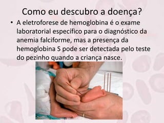 Como eu descubro a doença?
• A eletroforese de hemoglobina é o exame
laboratorial específico para o diagnóstico da
anemia falciforme, mas a presença da
hemoglobina S pode ser detectada pelo teste
do pezinho quando a criança nasce.
 