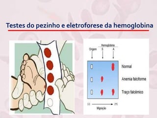 Testes do pezinho e eletroforese da hemoglobina
 