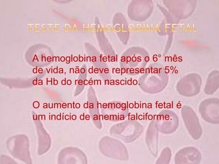 A hemoglobina fetal após o 6° mês
de vida, não deve representar 5%
da Hb do recém nascido.
O aumento da hemoglobina fetal é
um indício de anemia falciforme.
 