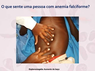 O que sente uma pessoa com anemia falciforme?
Esplenomegalia- Aumento do baço
 