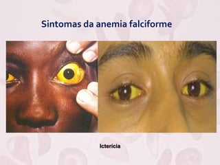 Sintomas da anemia falciforme
Icterícia
 