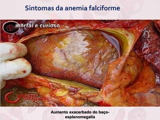 Sintomas da anemia falciforme
Aumento exacerbado do baço-
esplenomegalia
 