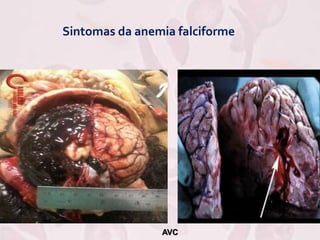 Sintomas da anemia falciforme
AVC
 