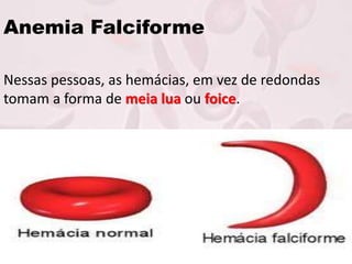 Anemia Falciforme
Nessas pessoas, as hemácias, em vez de redondas
tomam a forma de meia lua ou foice.
 