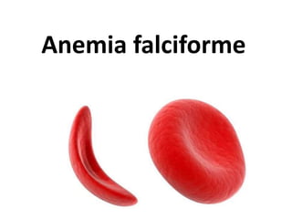 Anemia falciforme
 