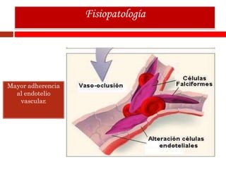 Mayor adherencia
al endotelio
vascular.
Fisiopatología
 