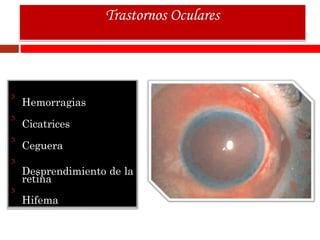 Hemorragias
Cicatrices
Ceguera
Desprendimiento de la
retina
Hifema
Trastornos Oculares
 