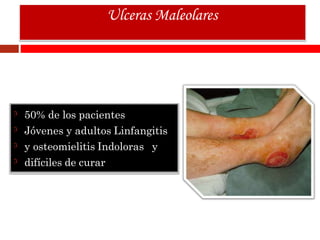 50% de los pacientes
Jóvenes y adultos Linfangitis
y osteomielitis Indoloras y
difíciles de curar
Ulceras Maleolares
 