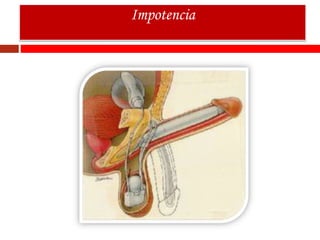 Impotencia
 