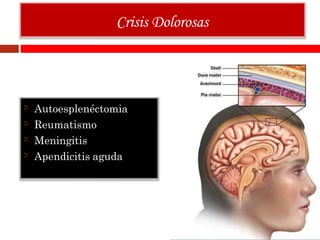 Autoesplenéctomia
Reumatismo
Meningitis
Apendicitis aguda
Crisis Dolorosas
 