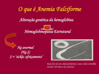 O que é Anemia Falciforme
Alteração genética da hemoglobina
Hemoglobinopatia Estrutural
Hg anormal
(Hg S)
S = ‘sickle: afoiçamento’
Rara foto de um celula falciforme e uma celula vermellha
normal. (Dr Bruce R. Cameron)
 