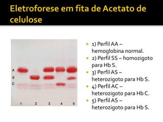  1) Perfil AA –
hemoglobina normal.
 2) Perfil SS – homozigoto
para Hb S.
 3) Perfil AS –
heterozigoto para Hb S.
 4) Perfil AC –
heterozigoto para Hb C.
 5) Perfil AS –
heterozigoto para Hb S.
 