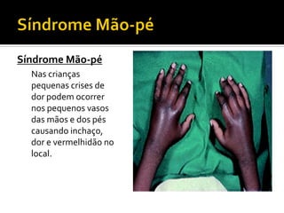 Síndrome Mão-pé
Nas crianças
pequenas crises de
dor podem ocorrer
nos pequenos vasos
das mãos e dos pés
causando inchaço,
dor e vermelhidão no
local.
 