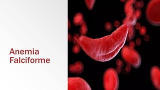 Anemia
Falciforme
 