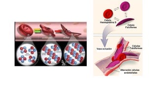 ANEMIA FALCIFORME, UNA BREVE EXPLICAIÓN.pptx