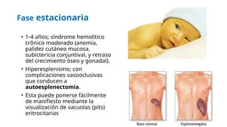 ANEMIA FALCIFORME, UNA BREVE EXPLICAIÓN.pptx