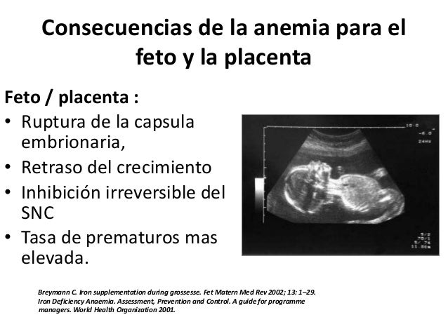 Anemia Ferropenica En El Embarazo