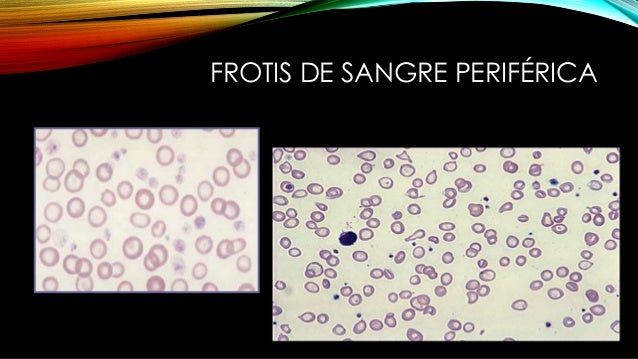 Anemia ferropenica 2015