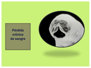 Pérdida
crónica
de sangre
 