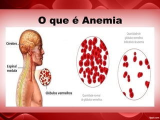 O que é Anemia
 
