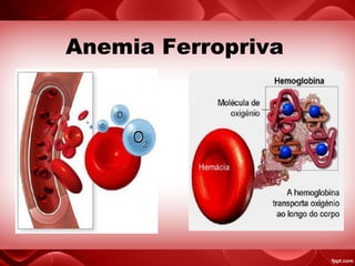 Anemia Ferropriva
 