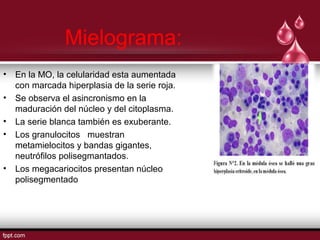 Mielograma: 
• En la MO, la celularidad esta aumentada 
con marcada hiperplasia de la serie roja. 
• Se observa el asincronismo en la 
maduración del núcleo y del citoplasma. 
• La serie blanca también es exuberante. 
• Los granulocitos muestran 
metamielocitos y bandas gigantes, 
neutrófilos polisegmantados. 
• Los megacariocitos presentan núcleo 
polisegmentado 
 