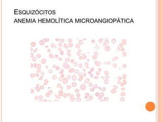ESQUIZÓCITOS
ANEMIA HEMOLÍTICA MICROANGIOPÁTICA
 