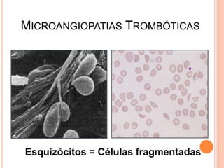 MICROANGIOPATIAS TROMBÓTICAS




Esquizócitos = Células fragmentadas
 