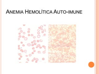 ANEMIA HEMOLÍTICA AUTO-IMUNE
 