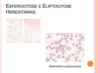 ESFEROCITOSE E ELIPTOCITOSE
HEREDITÁRIAS




                 Esferócitos e policromasia
 