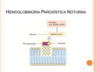 HEMOGLOBINÚRIA PAROXÍSTICA NOTURNA
 