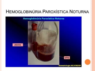 HEMOGLOBINÚRIA PAROXÍSTICA NOTURNA
 