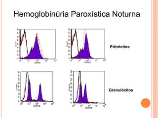 Hemoglobinúria Paroxística Noturna



                         Eritrócitos




                         Granulócitos
 