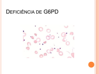 DEFICIÊNCIA DE G6PD
 