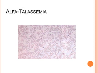 ALFA-TALASSEMIA
 