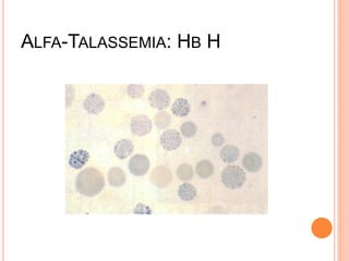 ALFA-TALASSEMIA: HB H
 