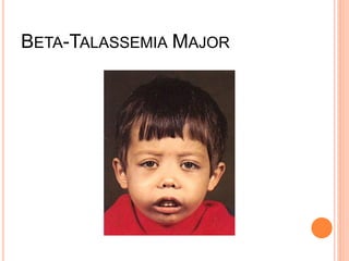 BETA-TALASSEMIA MAJOR
 