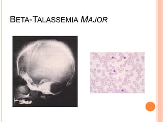 BETA-TALASSEMIA MAJOR
 