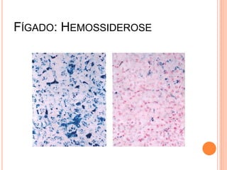 FÍGADO: HEMOSSIDEROSE
 