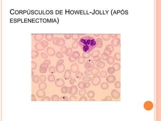 CORPÚSCULOS DE HOWELL-JOLLY (APÓS
ESPLENECTOMIA)
 