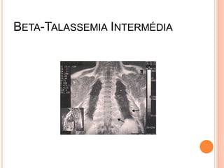 BETA-TALASSEMIA INTERMÉDIA
 