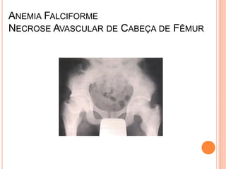 ANEMIA FALCIFORME
NECROSE AVASCULAR DE CABEÇA DE FÊMUR
 